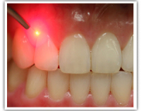 laser-dentistry-200x157[1]